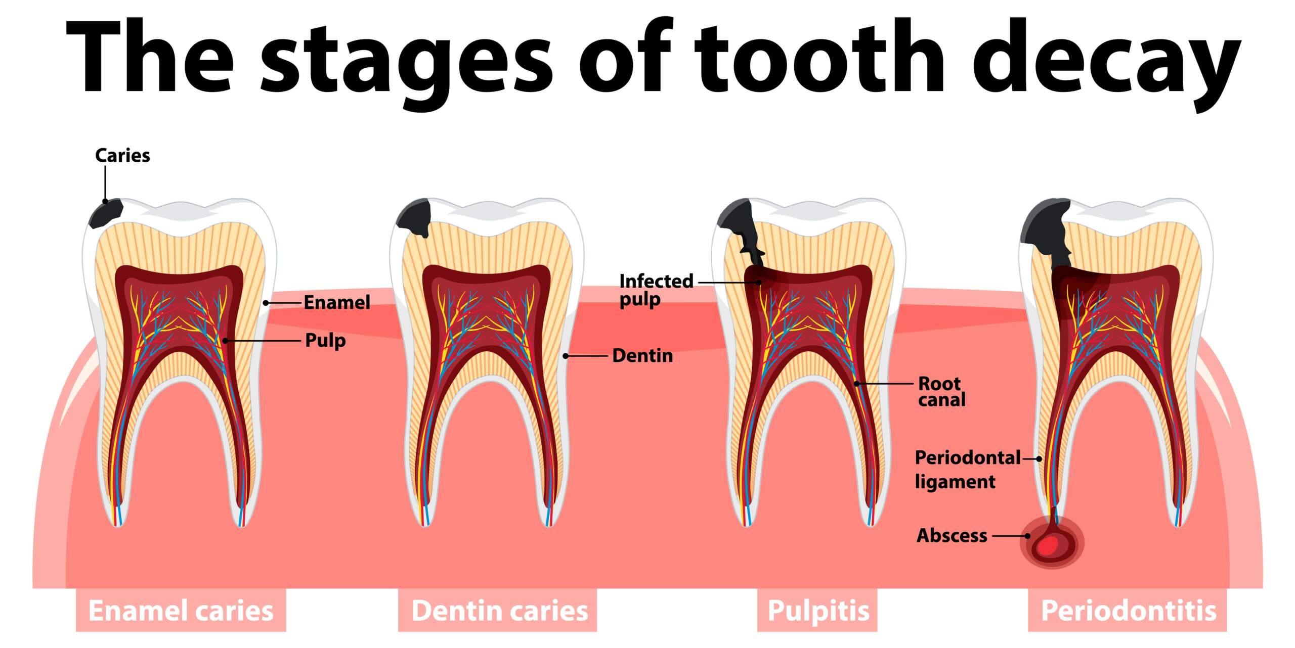 ROOT CANAL