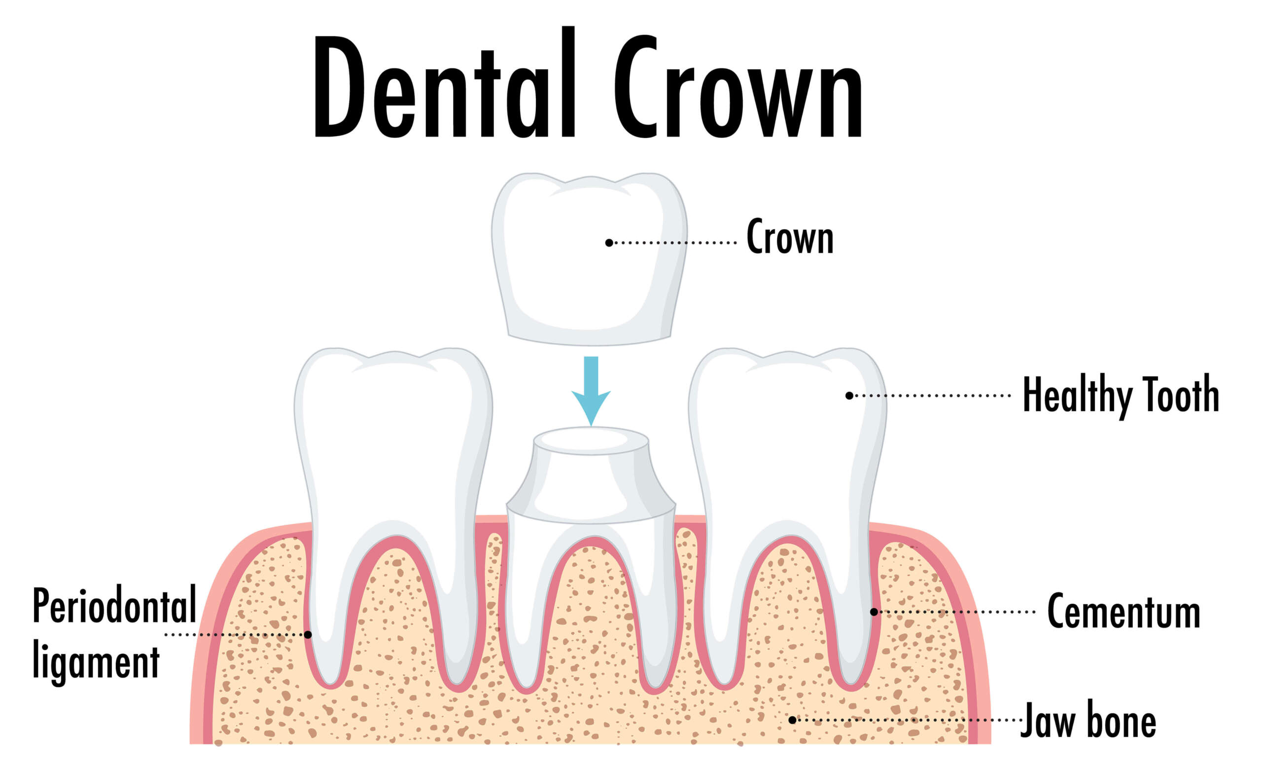 Dental Crowns