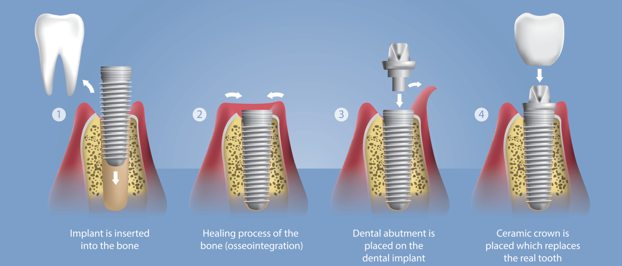 dental implants