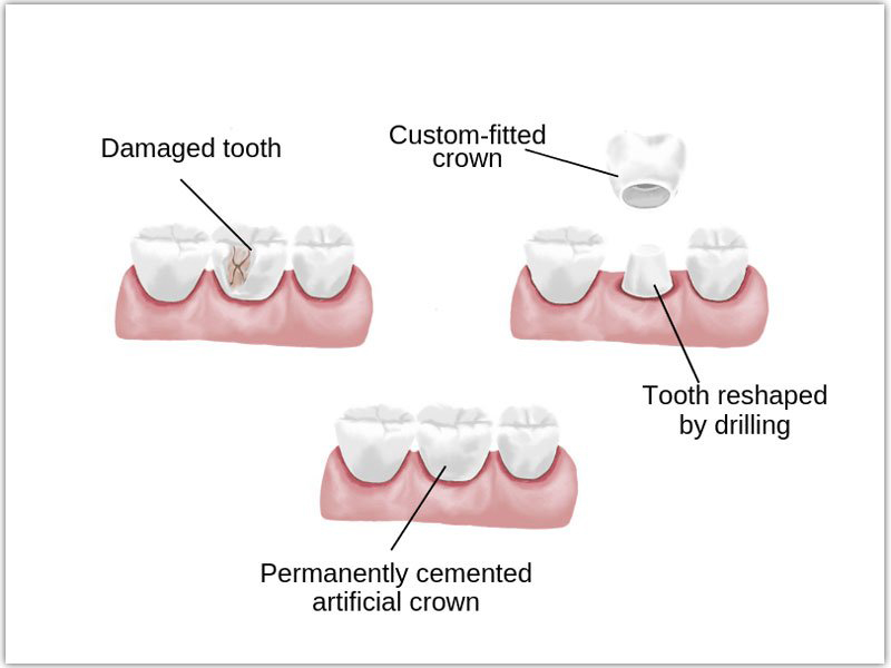 Dental Crowns