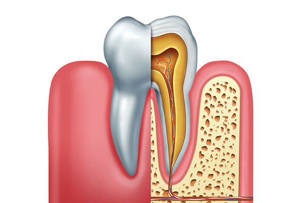 Cracked Tooth Syndrome