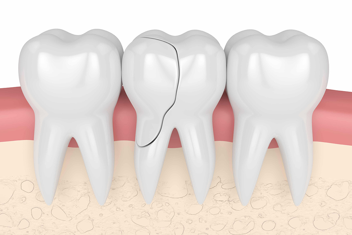 Cracked Tooth Syndrome