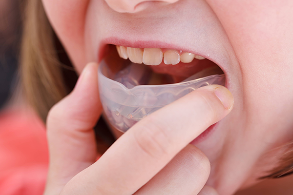 Over the counter mouth guard