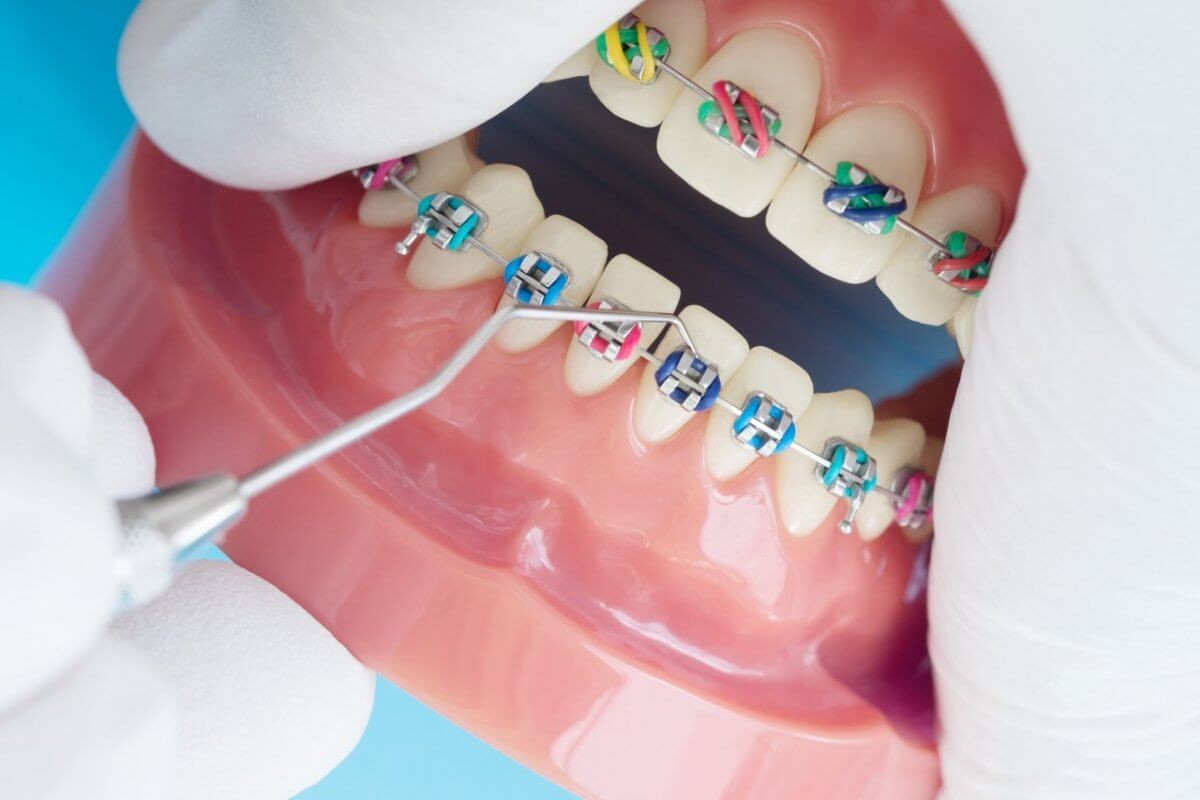 Placing the Braces