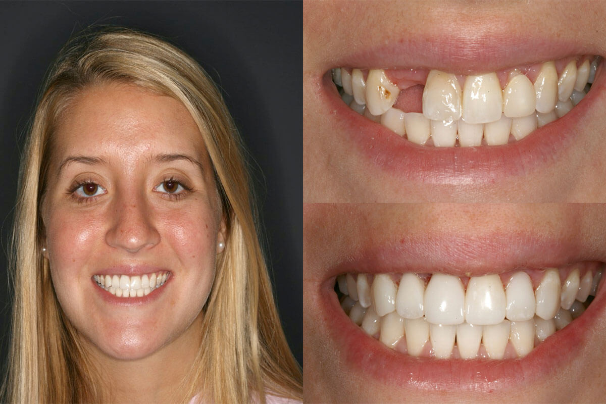 Composite Veneers