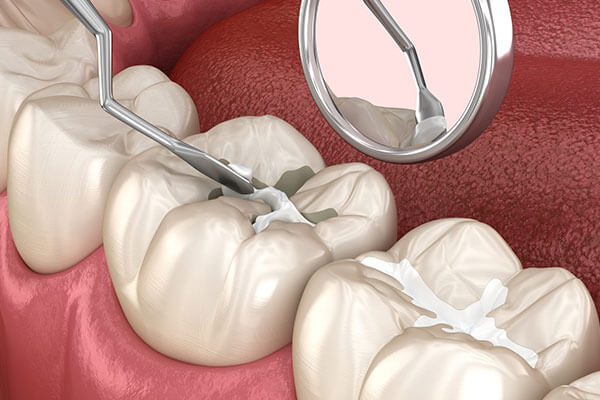 Dental Sealants