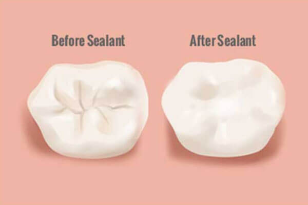 Dental Sealants