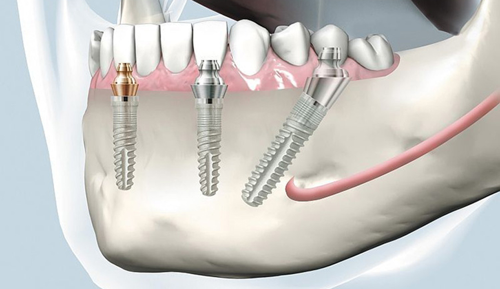 Jaw Surgery