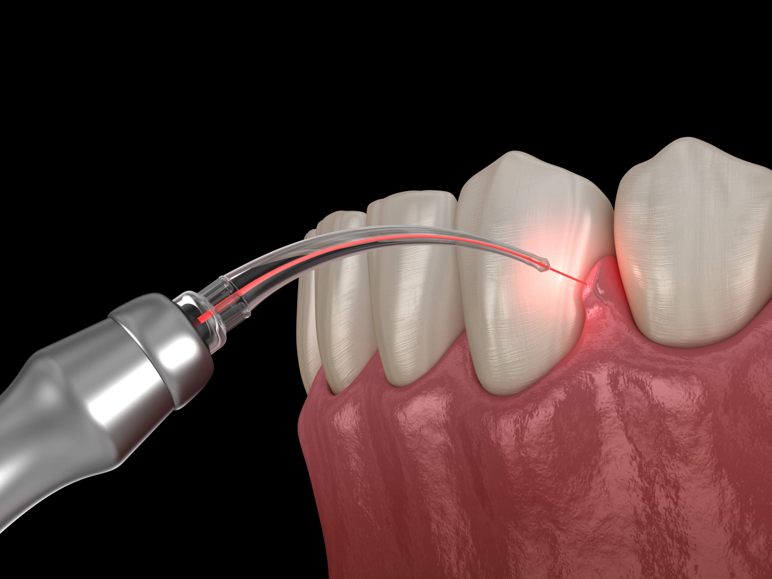 gum graft procedure on teeth
