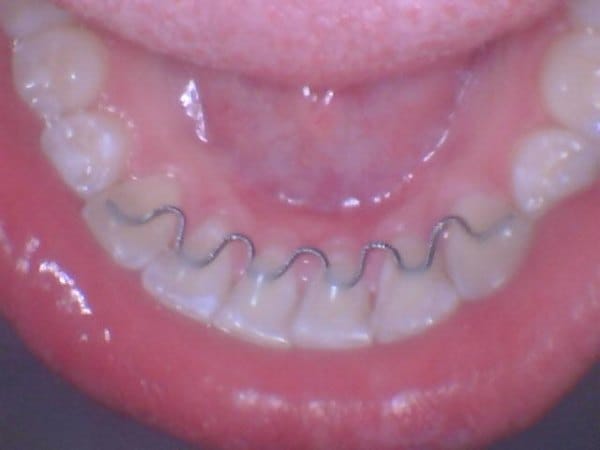 after_orthodontics