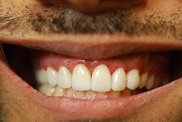 after_veneers