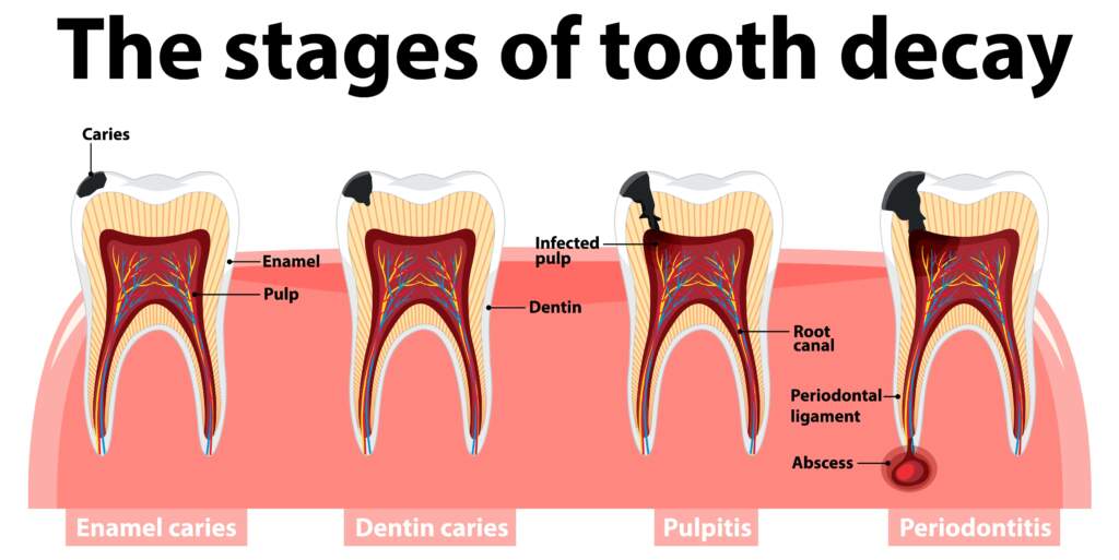 stages of tooth decay